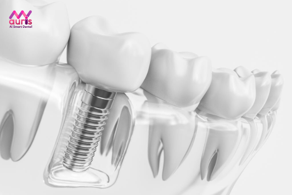 Trồng răng Implant được thực hiện như thế nào?