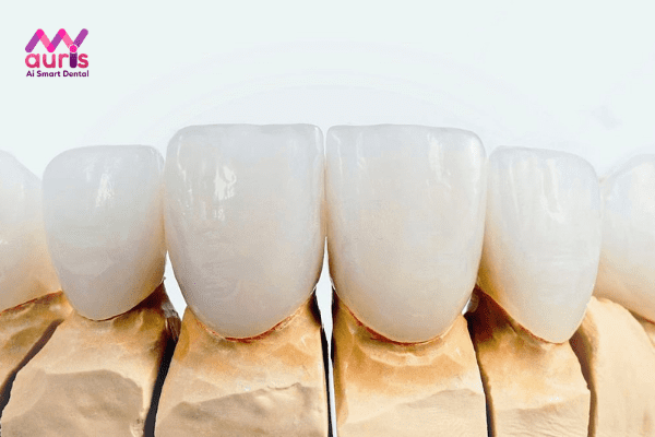 Răng sứ Emax Press có nhược điểm gì không?