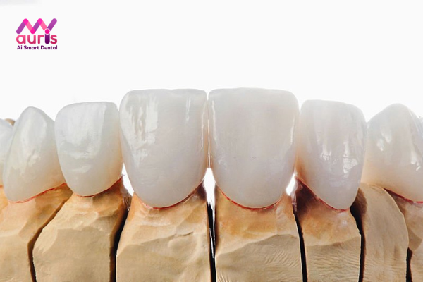 Răng toàn sứ có mấy loại
