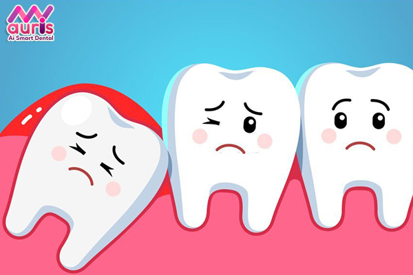 răng khôn mọc lệch ra má hàm dưới,rang khon moc lech ra ma ham duoi