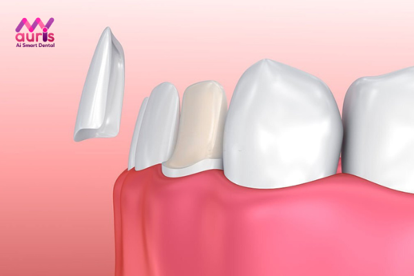 Giá bọc răng sứ bao nhiêu tiền với mặt dán sứ?