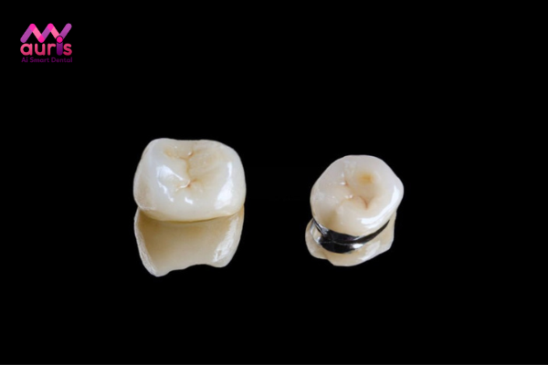 Giá bọc răng sứ bao nhiêu tiền với răng sứ kim loại?