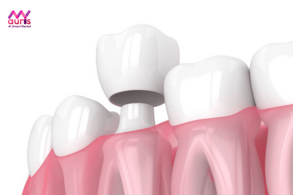 Bọc răng sứ thẩm mỹ là gì? những trường hợp không nên bọc răng sứ  
