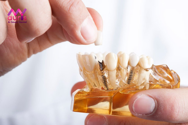 Tìm hiểu phương pháp trồng răng Implant