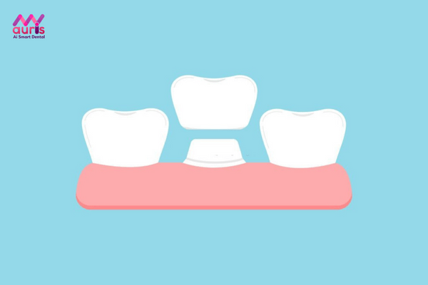 Có nên bọc răng sứ cho răng sâu không? 