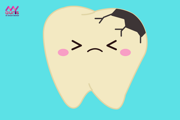 Bọc răng sứ có bị sâu răng lại không? có nên bọc răng sứ cho răng sâu