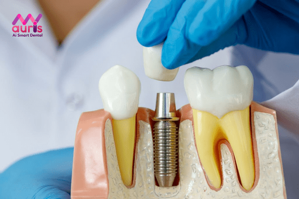 Trồng răng implant là phương pháp gì?