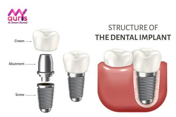 Tìm hiểu về trồng răng Implant có cấu tạo mấy phần?