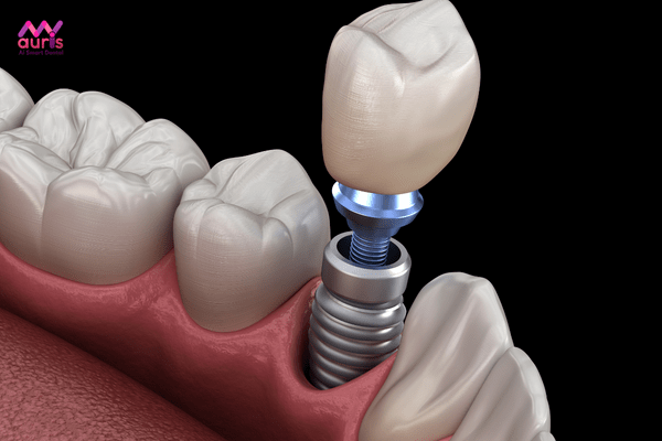Cấy ghép implant là gì? trồng răng bằng cấy ghép implant